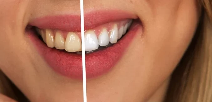 What Are The Advantages of Digital Smile Design